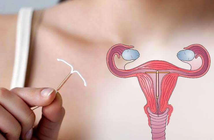 Спираль Мирена. Лучший выбор женской контрацепции 